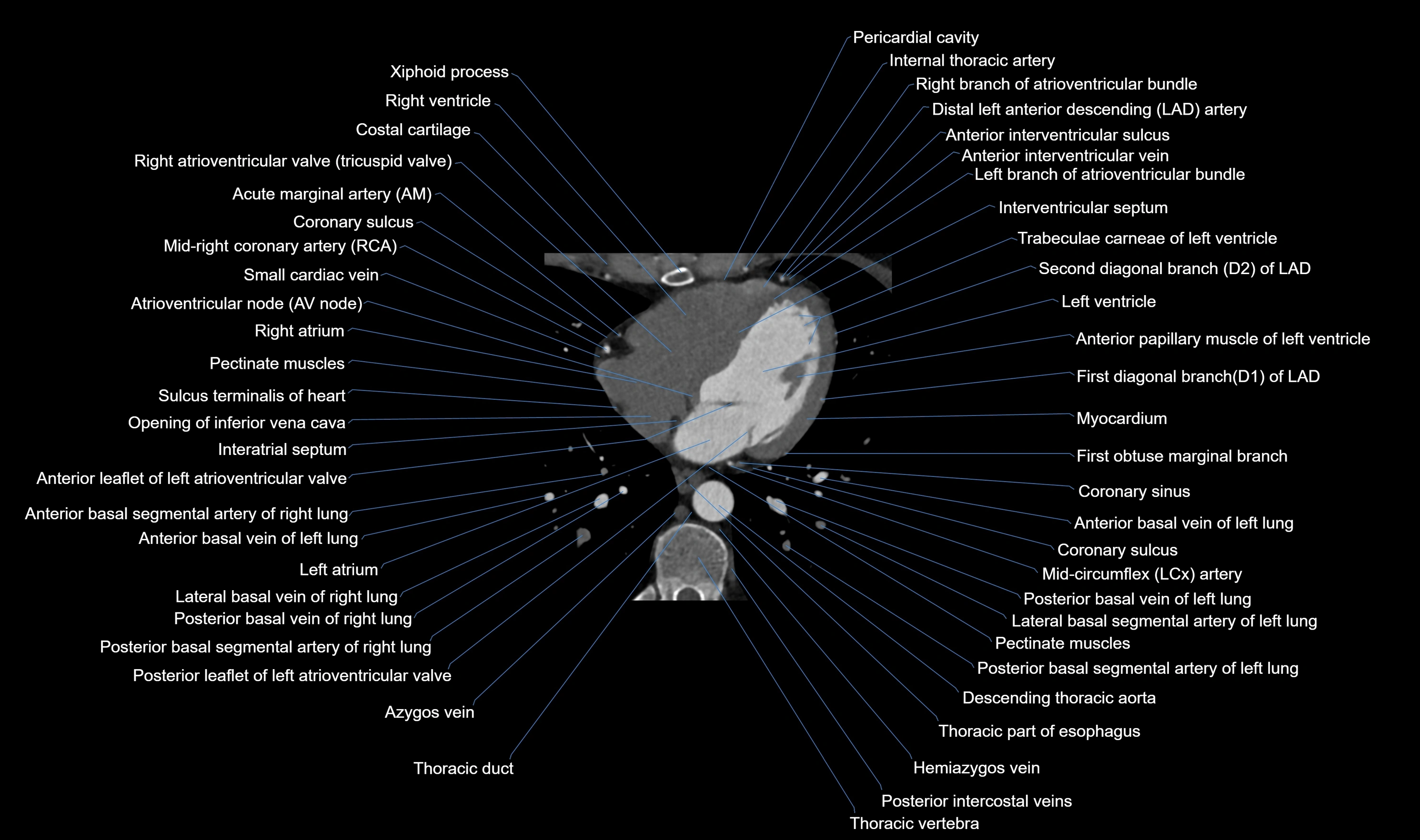 CT heart (coronary angiogram) axial view cross sectional anatomy labelled radiology image-00044.webp